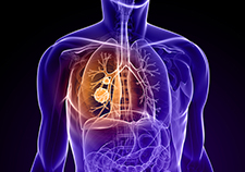 
Surgery vs. radiotherapy to treat non-small cell lung cancer 